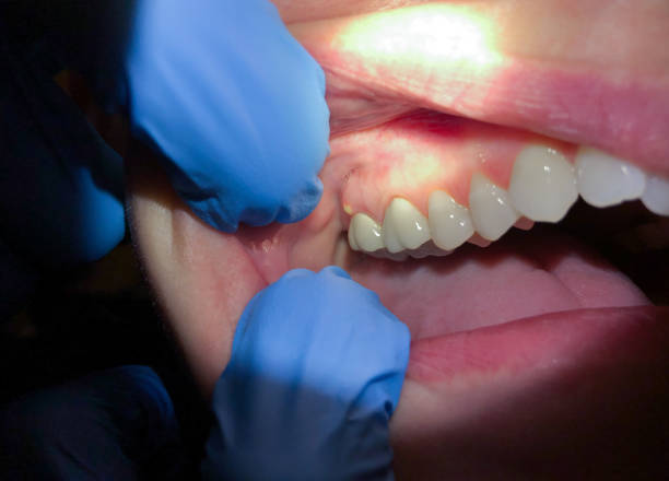 Best Emergency Treatment for Oral Infections in Shelbyville, KY